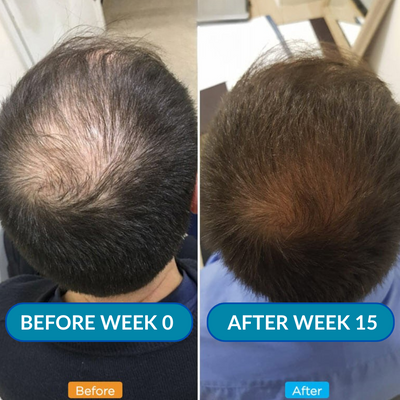 ONEFIX™ Advanced Micro - Infusion Hair Regrowth Set